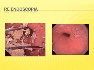 Re endoscopia