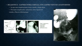 • POLYA: GASTRECTOMIA CON GASTRO-YEYUNO ANASTOMOSIS DE TODA
CIRCUNFERENCIA DE CORTE DEL ESTÓMAGO
 
