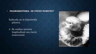 • Anastomosis erróneas:
• No se identifica ángulo de Trietz y se
anastomosa esógago con asa del íleon, y aun del
colon
• P...