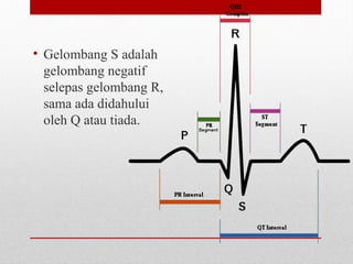 • Gelombang S adalah
gelombang negatif
selepas gelombang R,
sama ada didahului
oleh Q atau tiada.
 