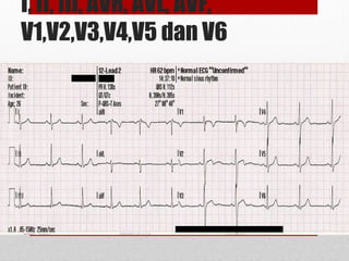 I, II, III, AVR, AVL, AVF,
V1,V2,V3,V4,V5 dan V6
 
