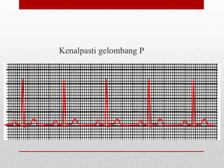Kenalpasti gelombang P
 