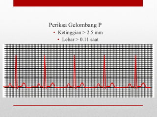 Periksa Gelombang P
• Ketinggian > 2.5 mm
• Lebar > 0.11 saat
 