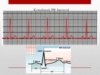 Kenalpasti PR Interval
 