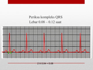 Periksa kompleks QRS
Lebar 0.08 – 0.12 saat
2 X 0.04 = 0.08
 