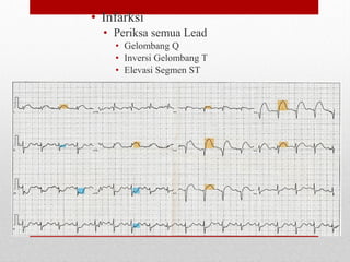 • Infarksi
• Periksa semua Lead
• Gelombang Q
• Inversi Gelombang T
• Elevasi Segmen ST
 