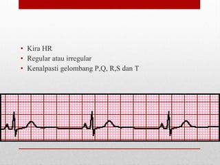 • Kira HR
• Regular atau irregular
• Kenalpasti gelombang P,Q, R,S dan T
 