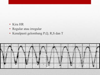 • Kira HR
• Regular atau irregular
• Kenalpasti gelombang P,Q, R,S dan T
 
