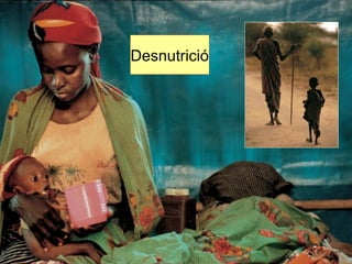 Desnutrició 
 