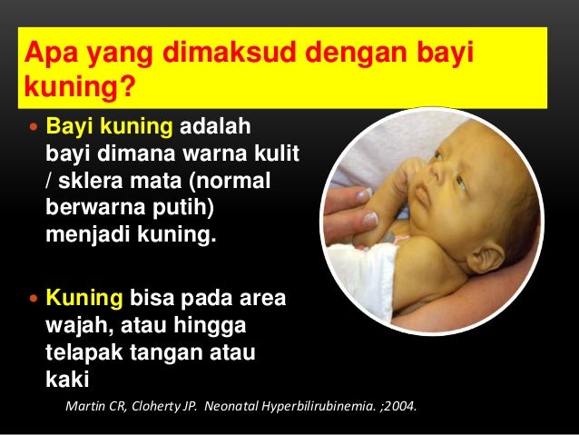 Mengenali bayi kuning dan penanganannya