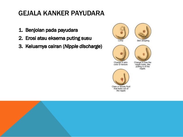 Apakah Kanker Payudara Termasuk Penyakit Keturunan Apakah Kanker Payudara Termasuk Penyakit Keturunan