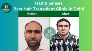 Hair & Senses
Best Hair Transplant Clinic In Delhi
 