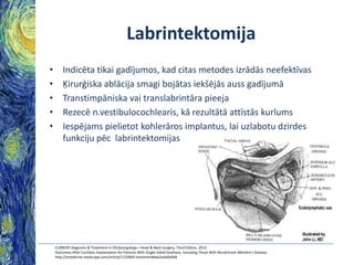 Labrintektomija
•
•
•
•
•

Indicēta tikai gadījumos, kad citas metodes izrādās neefektīvas
Ķirurģiska ablācija smagi bojātas iekšējās auss gadījumā
Transtimpāniska vai translabrintāra pieeja
Rezecē n.vestibulocochlearis, kā rezultātā attīstās kurlums
Iespējams pielietot kohlerāros implantus, lai uzlabotu dzirdes
funkciju pēc labrintektomijas

CURRENT Diagnosis & Treatment in Otolaryngology—Head & Neck Surgery, Third Edition, 2012
Outcomes After Cochlear Implantation for Patients With Single-Sided Deafness, Including Those With Recalcitrant Ménière's Disease.
http://emedicine.medscape.com/article/1159069-treatment#aw2aab6b6b8

 
