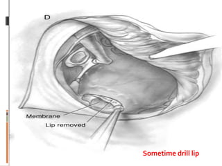Sometime drill lip
 