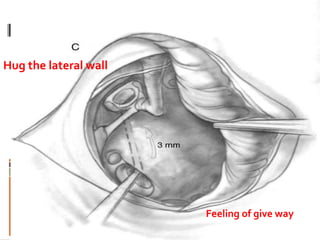 Hug the lateral wall
Feeling of give way
 