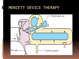 MENIETT DEVICE THERAPY
 