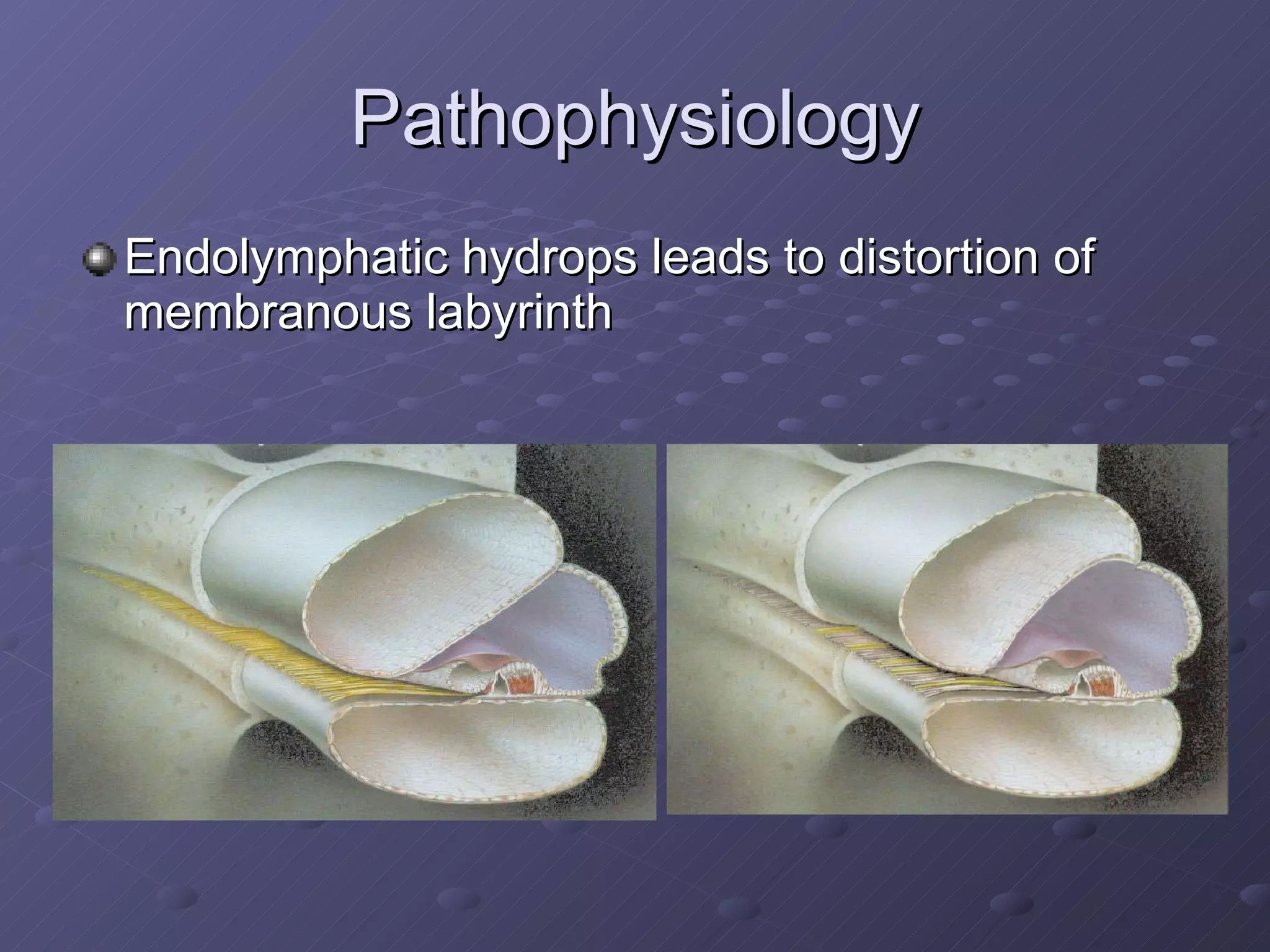 Pathophysiology Endolymphatic hydrops leads to distortion of membranous labyrinth 