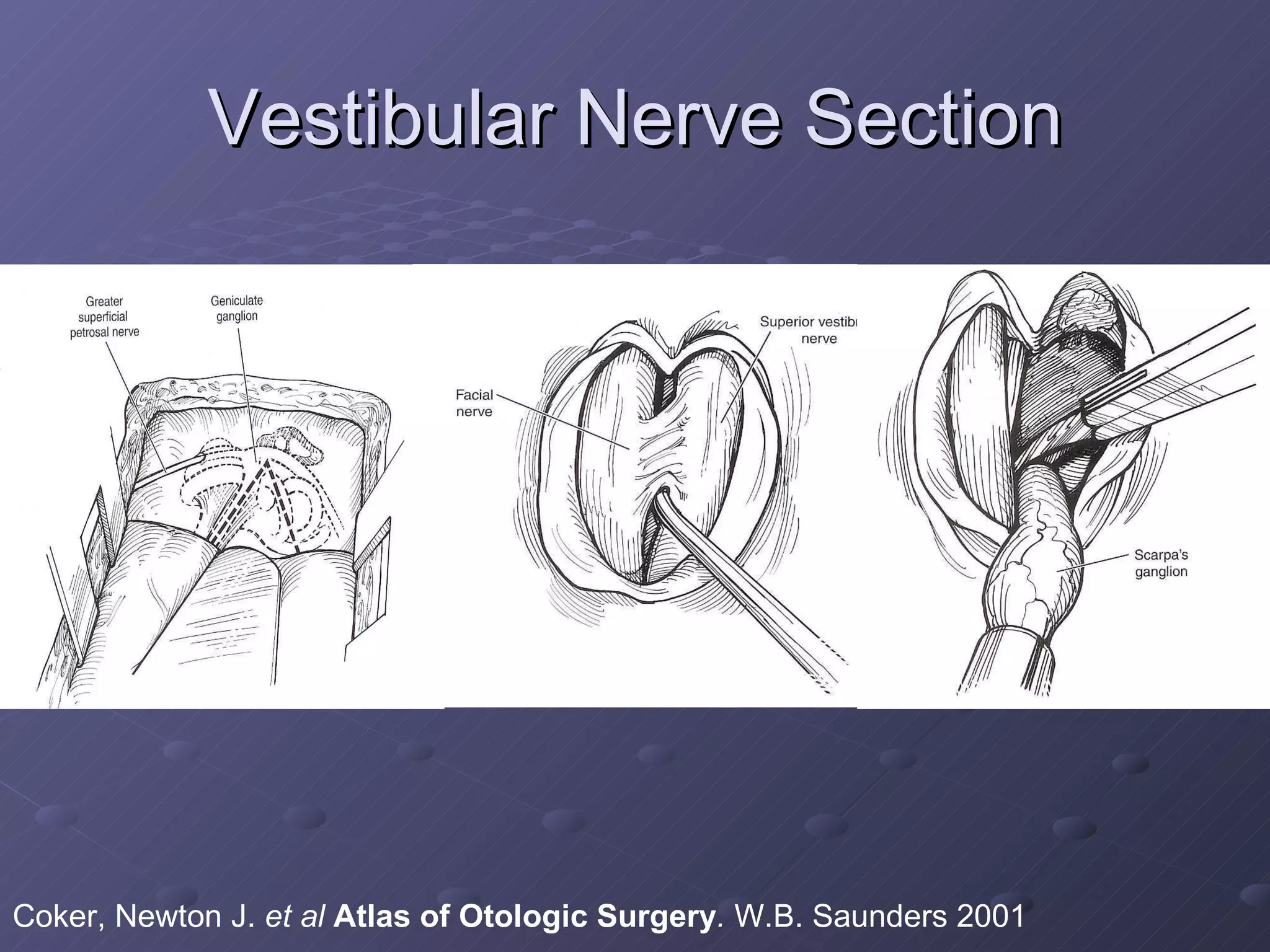 Vestibular Nerve Section Coker, Newton J.  et al   Atlas of Otologic Surgery .  W.B. Saunders 2001 