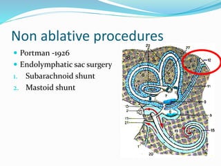 Non ablative procedures
 Portman -1926
 Endolymphatic sac surgery
1. Subarachnoid shunt
2. Mastoid shunt
 