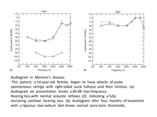 Audiogram in Meniere's disease.
This patient, a 14-year-old female, began to have attacks of acute
spontaneous vertigo with right-sided aural fullness and then tinnitus. (a)
Audiogram on presentation shows a 60 dB low-frequency
Hearing loss with normal acoustic reflexes (Z), indicating a fully
recruiting cochlear hearing loss. (b) Audiogram after four months of treatment
with a rigorous low-sodium diet shows normal pure-tone thresholds.
 