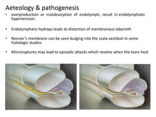 Aeteology & pathogenesis
• overproduction or malabsorption of endolymph, result in endolymphatic
hypertension.
• Endolymphatic hydrops leads to distortion of membranous labyrinth
• Reisner’s membrane can be seen bulging into the scala vestibuli in some
histologic studies
• Microruptures may lead to episodic attacks which resolve when the tears heal
 