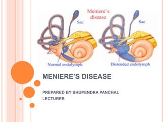 MENIERE’S DISEASE
PREPARED BY BHUPENDRA PANCHAL
LECTURER
 