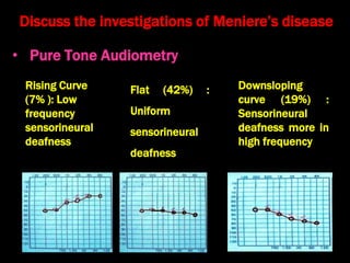 Rising Curve
(7% ): Low
frequency
sensorineural
deafness
Discuss the investigations of Meniere’s disease
Flat (42%) :
Uniform
sensorineural
deafness
Downsloping
curve (19%) :
Sensorineural
deafness more in
high frequency
• Pure Tone Audiometry
 