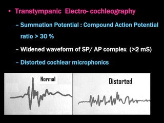 • Transtympanic Electro- cochleography
– Summation Potential : Compound Action Potential
ratio > 30 %
– Widened waveform of SP/ AP complex (>2 mS)
– Distorted cochlear microphonics
 