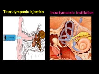Trans-tympanic injection Intra-tympanic instillation
 