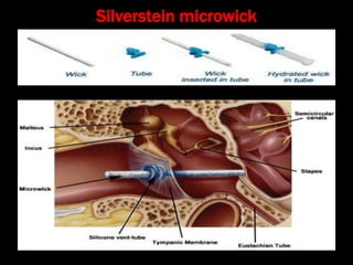 Silverstein microwick
 