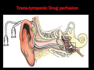 Trans-tympanic Drug perfusion
 