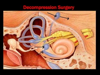 Decompression Surgery
 