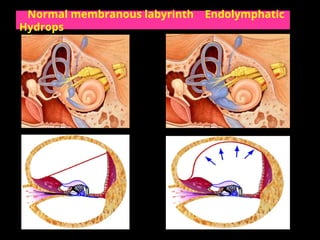 Endolymph Labyrinth Meniere's Disease .ppt by Dr. Krishna Koirala | PPT