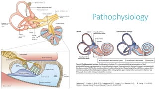 Pathophysiology
Nakashima, T., Pyykkö, I., Arroll, M. A., Casselbrant, M. L., Foster, C. A., Manzoor, N. F., ... & Young, Y. H. (2016).
Meniere's disease.Nature Reviews Disease Primers, 2, nrdp201628.
 
