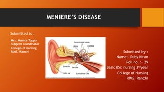MENIERE’S DISEASE
Submitted to :
Submitted by :
Name:- Ruby Kiran
Roll no. :- 29
Basic BSc nursing 3rdyear
College of Nursing
RIMS, Ranchi
Mrs. Mamta Toppo
Subject coordinator
College of nursing
RIMS, Ranchi
 