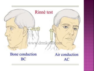 Rinner Abnormal Menier's disease & tonsilitis | PPTX