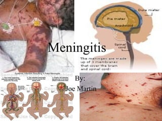 Meningitis By:  Joe Martin 
