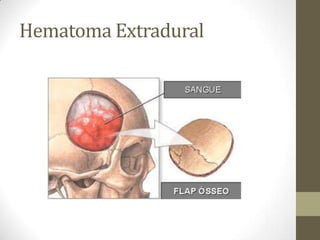 Hematoma Extradural

 