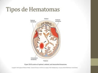 Tipos de Hematomas

 
