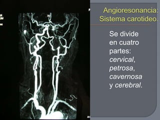 Se divide
en cuatro
partes:
cervical,
petrosa,
cavernosa
y cerebral.
 