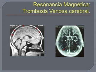 Meninges circulacioncerebral