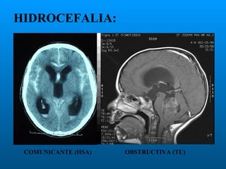 HIDROCEFALIA:

COMUNICANTE (HSA)

OBSTRUCTIVA (TU)

 