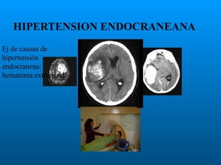HIPERTENSION ENDOCRANEANA
Ej de causas de
hipertensión
endocranena:
hematoma extradural

 