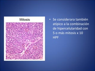 • Se considerara también
atípico a la combinación
de hipercelularidad con
5 o más mitosis x 10
HPF
 