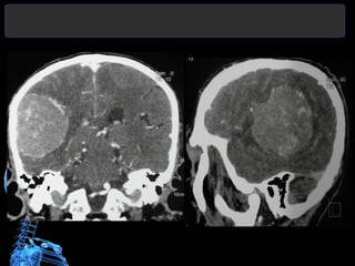 Bone destruction by meningiomas is an
uncommon feature, found in approximately 3%
of cases. Benign as well as malignant
me...