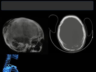 Peritumoral edema (PTE).
About 60% of meningiomas are associated with
PTE. It is more common with large lesions but
may be...
