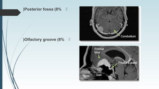 Posterior fossa (8%(
Olfactory groove (8%(
 