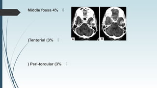 Middle fossa 4%
Tentorial (3%(
Peri-torcular (3%(
 