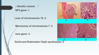 Genetic causes:
1-NF2 gene
2-Loss of chromosome 10
3-Monosomy of chromosome 7
4-smo gene
5-Gorlinand Rubinstein-Taybi syndromes
 