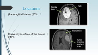Locations
Parasagittal/falcine (25%(
Convexity (surface of the brain(
(19%(
 